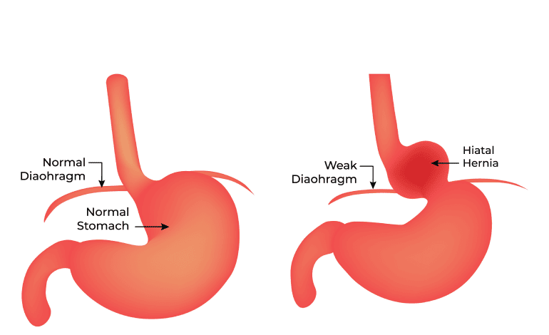Hernia hiatal en niños y adultos